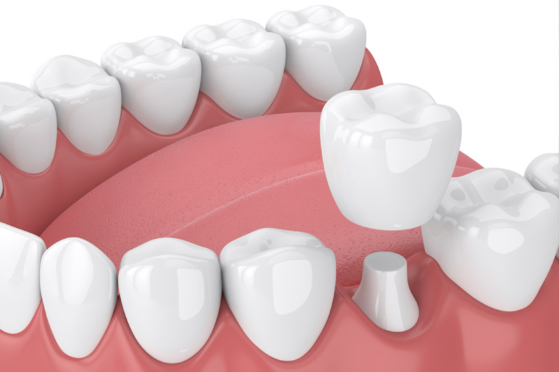 Dental Crowns in Crofton