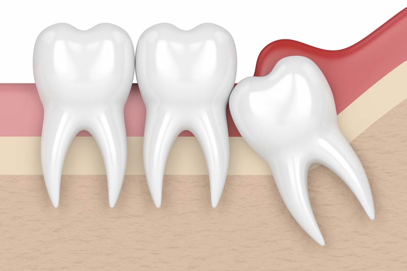 Wisdom Tooth Removal in Crofton